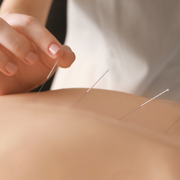 patient receiving acupuncture